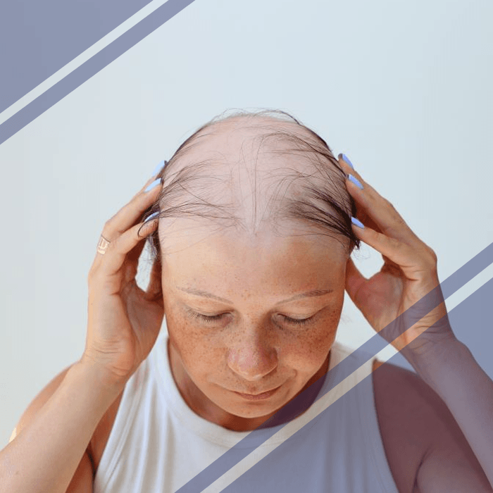 Alopecia Kerlab en mujeres